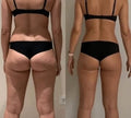 LUMA Pro - Ultrasonic Body Toner & Cellulite Remover