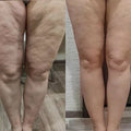 LUMA Pro - Ultrasonic Body Toner & Cellulite Remover